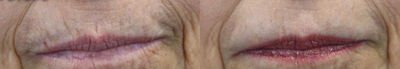Restylane Silk before and after photo