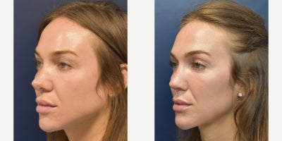 Revision Rhinoplasty before and after photo