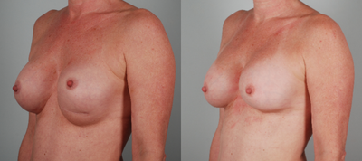 Breast Implant Revision before and after photo