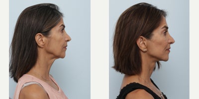Eyelid Surgery before and after photo