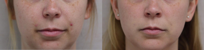 PicoWay before and after photo