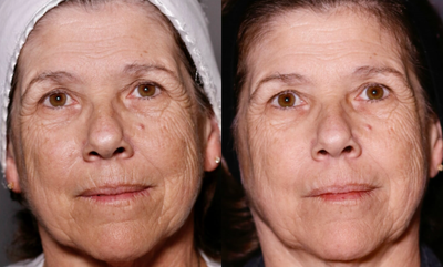 Restylane before and after photo