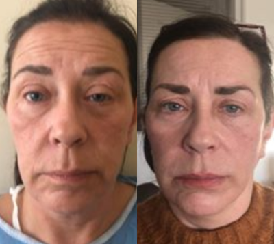 Facelift before and after photo
