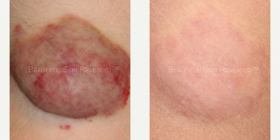 Laser Resurfacing before and after photo