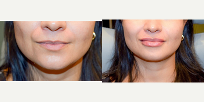 Lip Fillers before and after photo