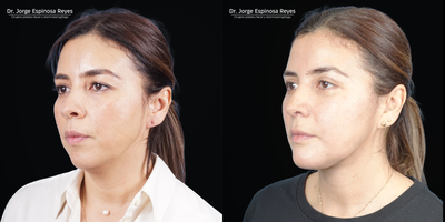 Neck Lift before and after photo