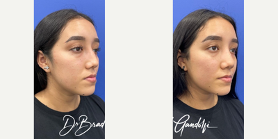 Rhinoplasty before and after photo