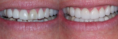 Dental Crown before and after photo