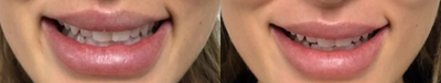 Hyaluronidase before and after photo