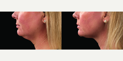 CoolSculpting before and after photo