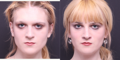 Lip Lift before and after photo