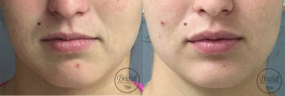 Restylane Silk before and after photo
