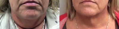 Chin Filler before and after photo