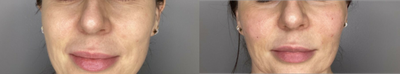 PRP Injections before and after photo