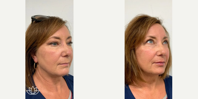 Chin Filler before and after photo
