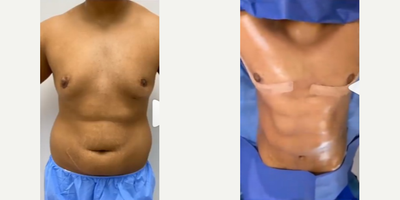 Liposculpture before and after photo