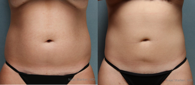 Liposuction before and after photo
