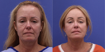 Neck Lift before and after photo