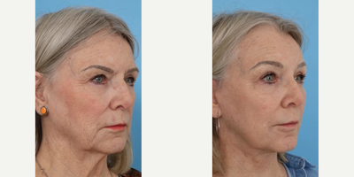 Restylane before and after photo