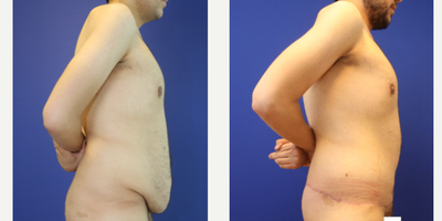Tummy Tuck before and after photo