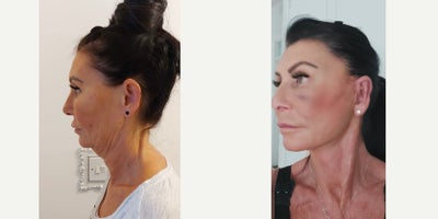 Brow Lift before and after photo