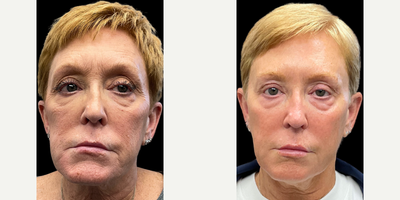 Cheek Fillers before and after photo