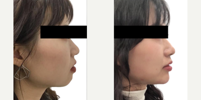 Chin Filler before and after photo