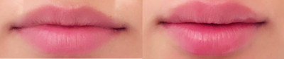 Dermal Fillers before and after photo