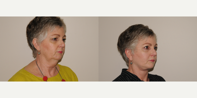 Lower Facelift before and after photo