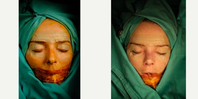 Rhinoplasty before and after photo