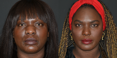 African American Rhinoplasty before and after photo