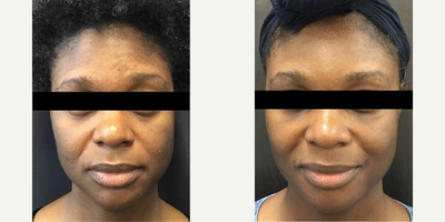 Belotero before and after photo