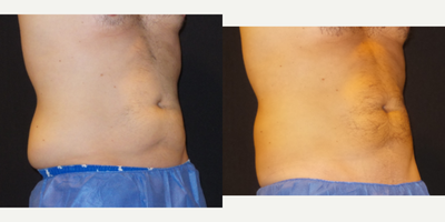 CoolSculpting before and after photo