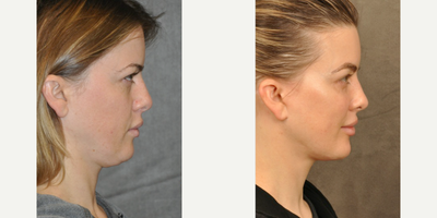 Facelift before and after photo