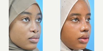 Revision Rhinoplasty before and after photo