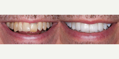 Teeth Whitening before and after photo