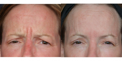 Dysport before and after photo