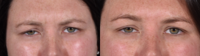 Dysport before and after photo