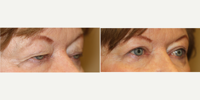 Eyelid Surgery before and after photo