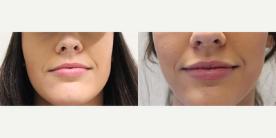 Juvederm before and after photo