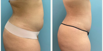 Liposuction before and after photo