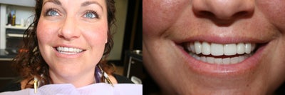 Lumineers before and after photo