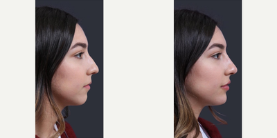 Nonsurgical Nose Job before and after photo