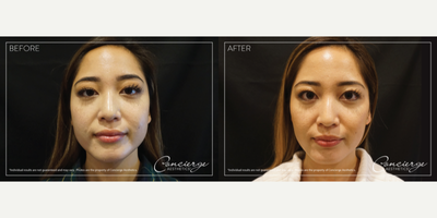 Botox before and after photo