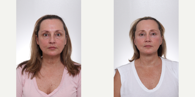 Brow Lift before and after photo