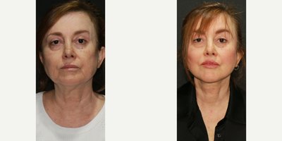 Dermal Fillers before and after photo