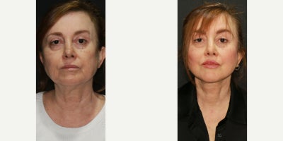 Dermal Fillers before and after photo