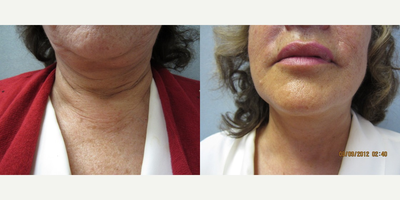 Neck Lift before and after photo