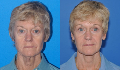 Eyelid Surgery before and after photo