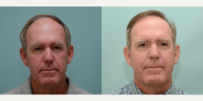 Hair Transplant before and after photo